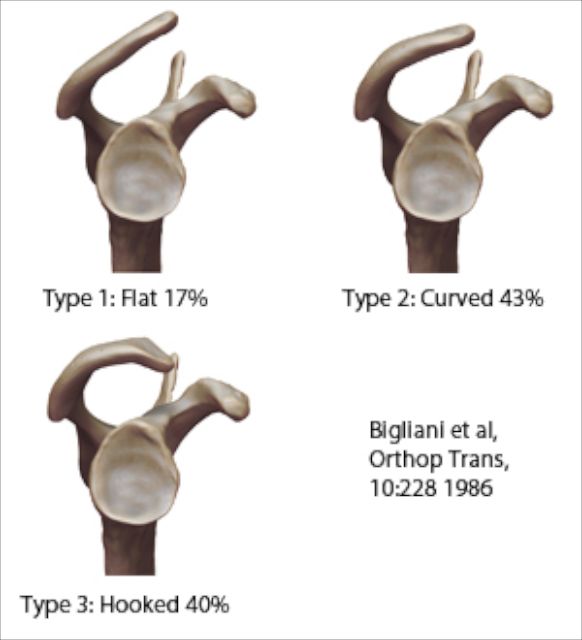 Différents types d'acromions selon Bigliani