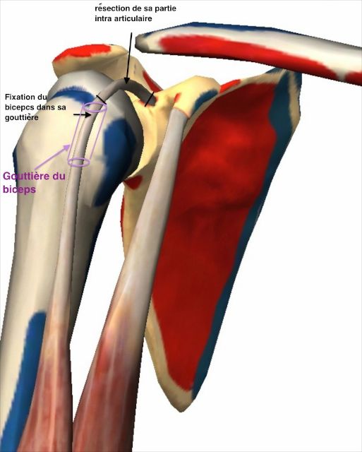Ténotomie (coupure) et ténodèse (fixation) du biceps dans le cas 
        d'une rupture massive de la coiffe des rotateurs sans arthrose excentrée