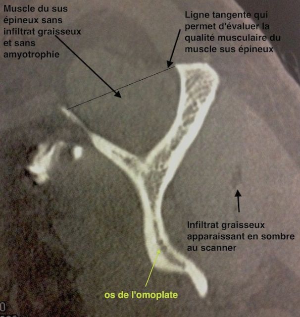 Vue sagitale (de profil) des muscles de la coiffe pour évaluer la 
        fonte musculaire (amyotrophie) et l'infiltrat graisseux à l'arthro-scanner