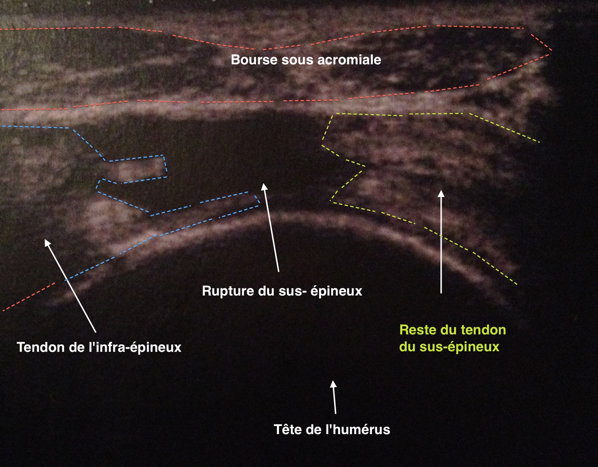 Vue échographique d'une rupture des tendons de la coiffe