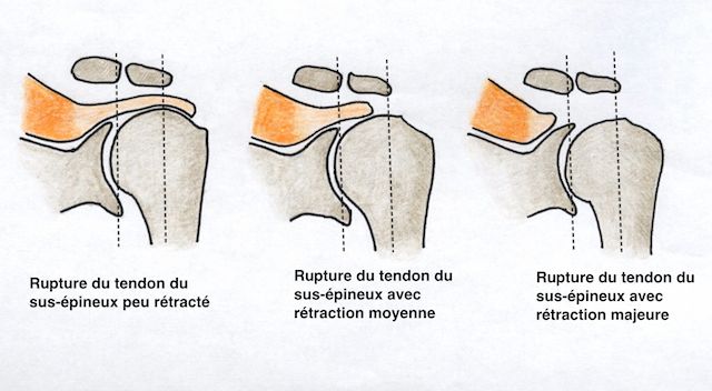 Evolution d'une rupture des tendons de la coiffe