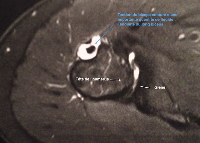 IRM d'une tendinite du long-biceps