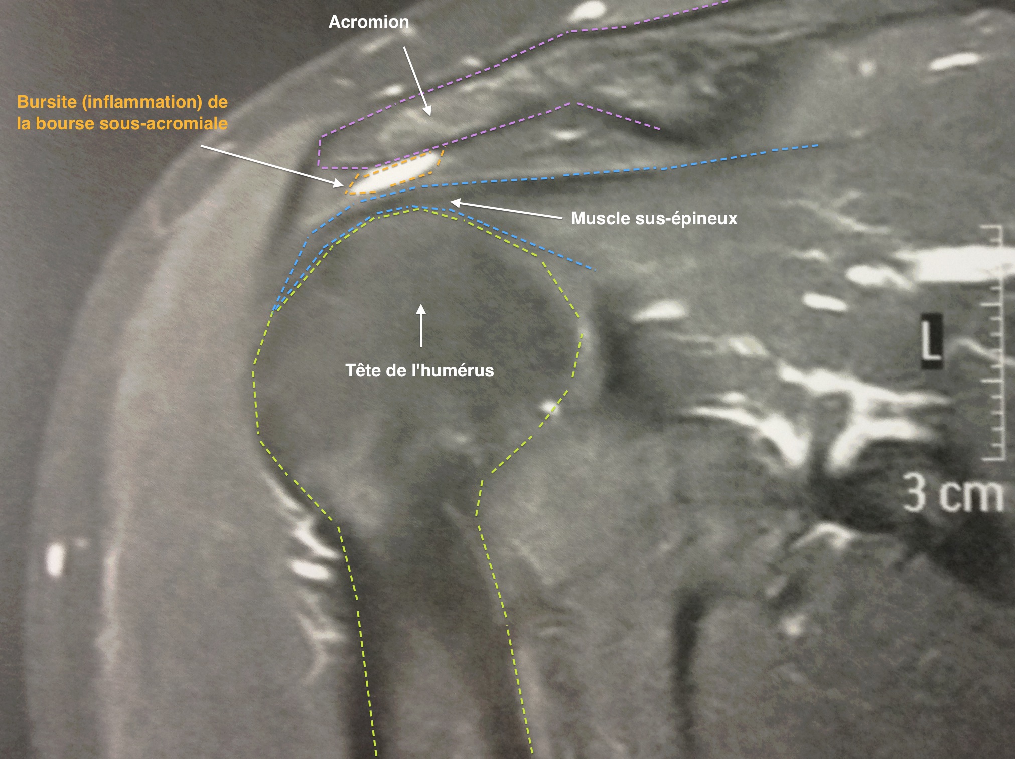 IRM d'une tendinite du sus-épineux