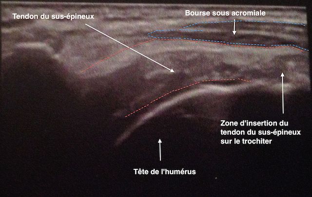 Echographie d'une tendinite du sus-épineux