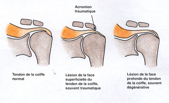 Rupture partielle du tendon du sus-épineux