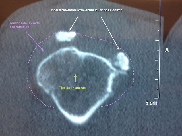 Calcification intra-tendineuse vue de profil à l'arthroscanner