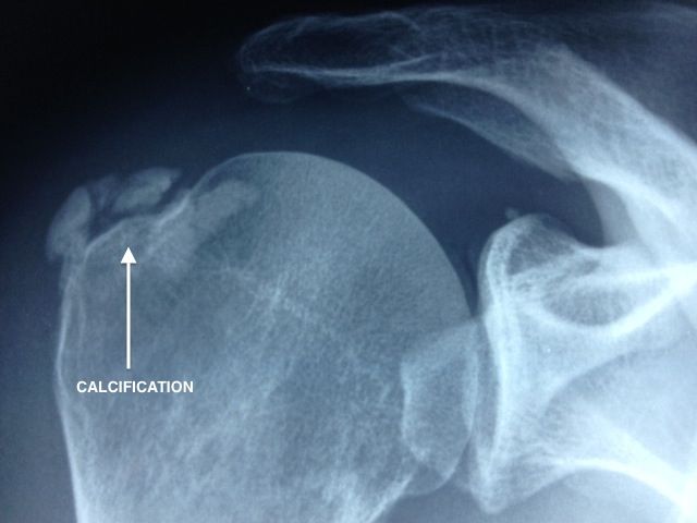 Calcification de type B