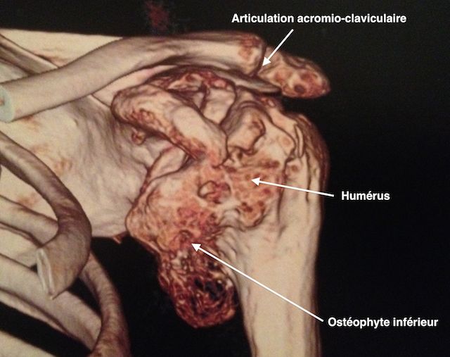 reconstruction au scanner 3D d'une omarthrose centrée