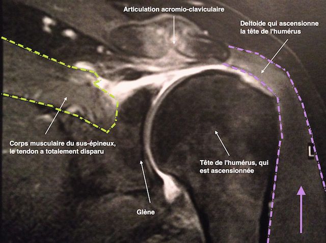 IRM d'une rupture étendue de la coiffe