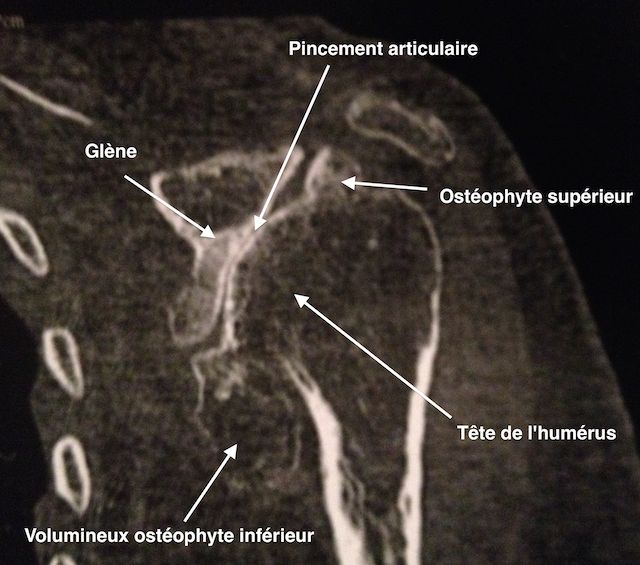 Erosion du cartilage