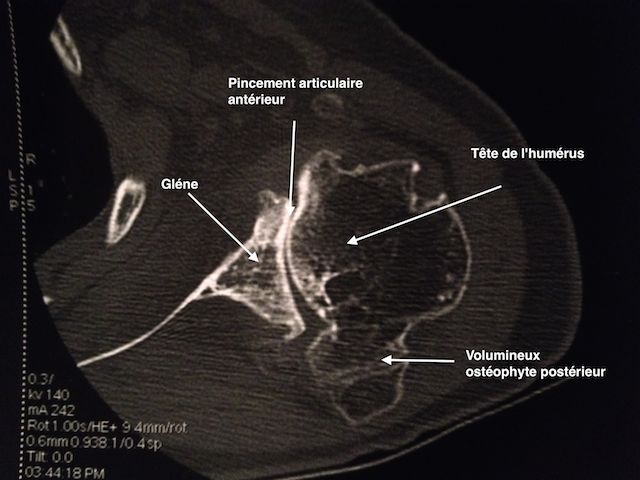 coupe scanner d'une omarthrose centrée