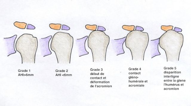 Evolution d'une arthrose d'épaule excentrée