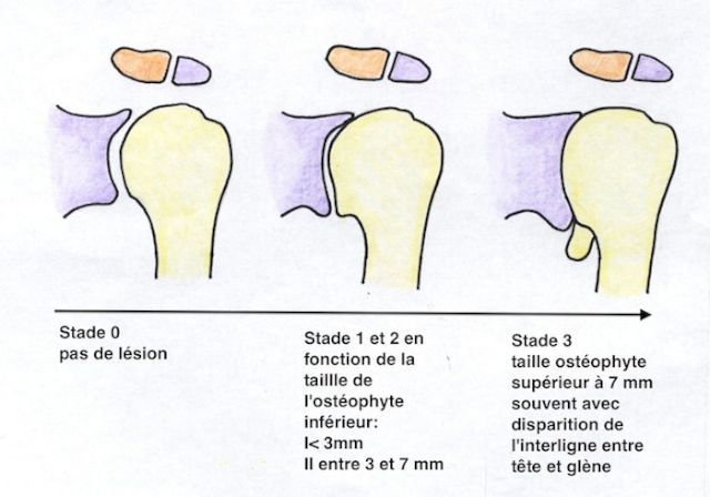 Evolution d'une arthrose d'épaule centrée