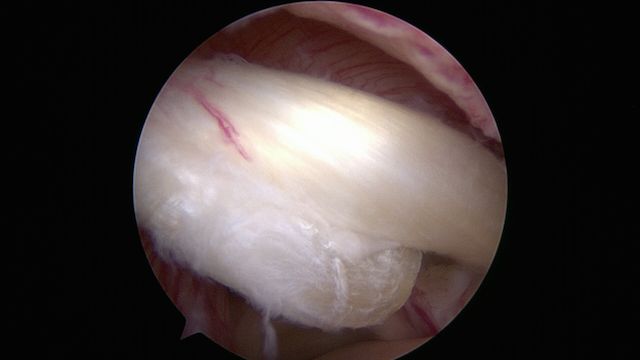 biceps lésé vu sous arthroscopie