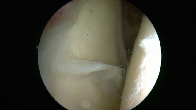 bourrelet lésé vu sous arthroscopie