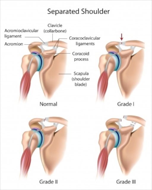 classification des 
            luxations acromio-claviculaires