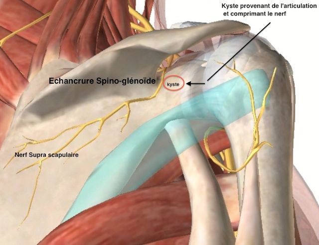 kyste comprimant le nerf supra-scapulaire