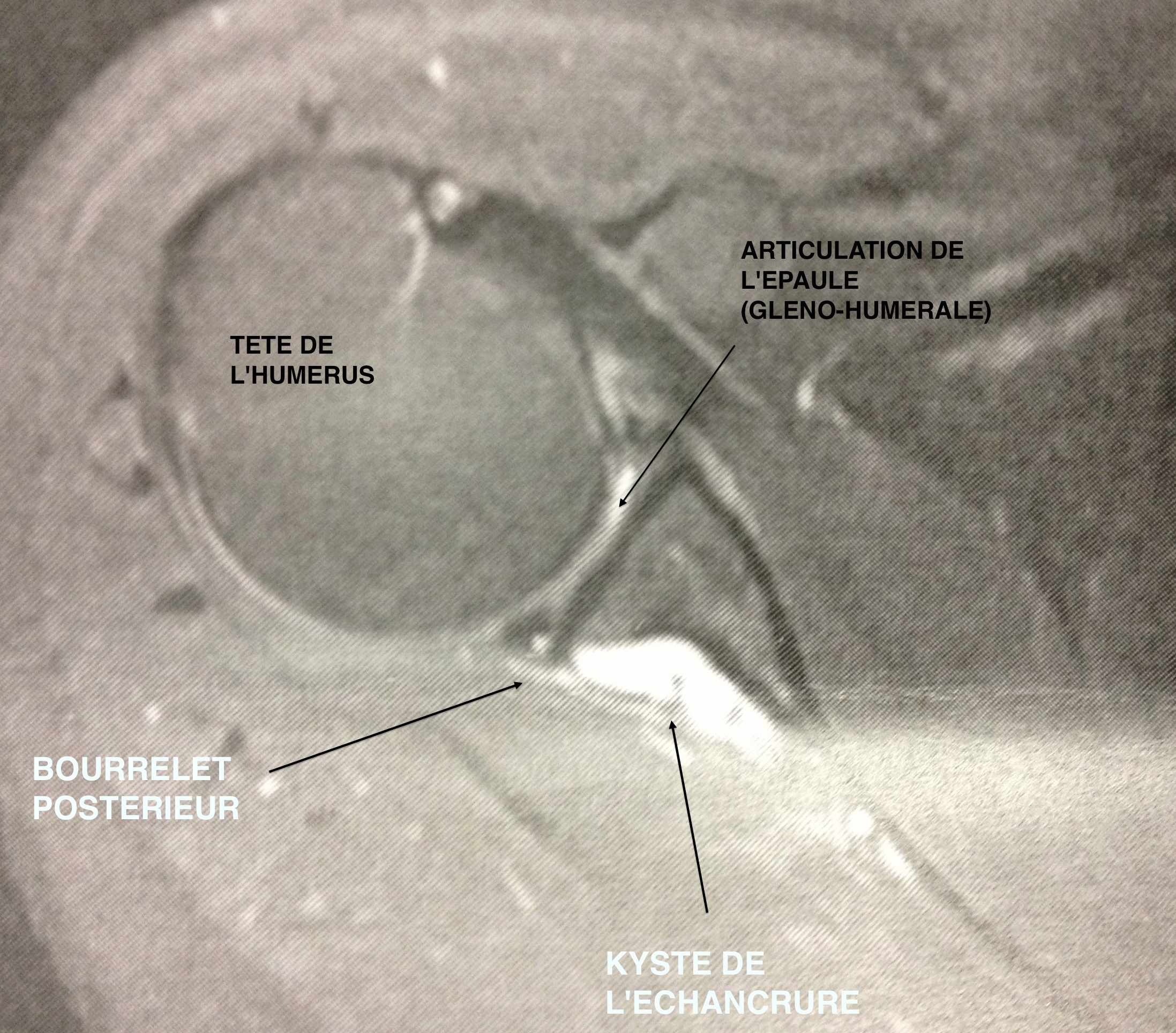 IRM montrant kyste comprimant le nerf supra-scapulaire