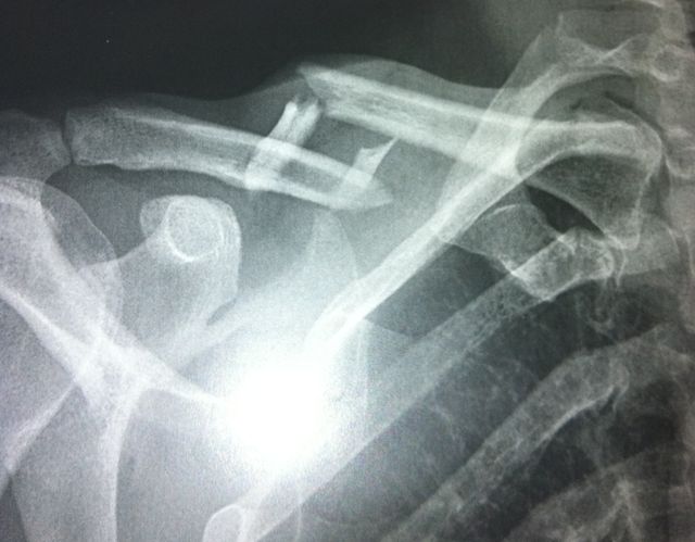 fracture de la clavicule