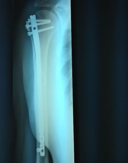 fracture réduite par la pose d'un clou huméral