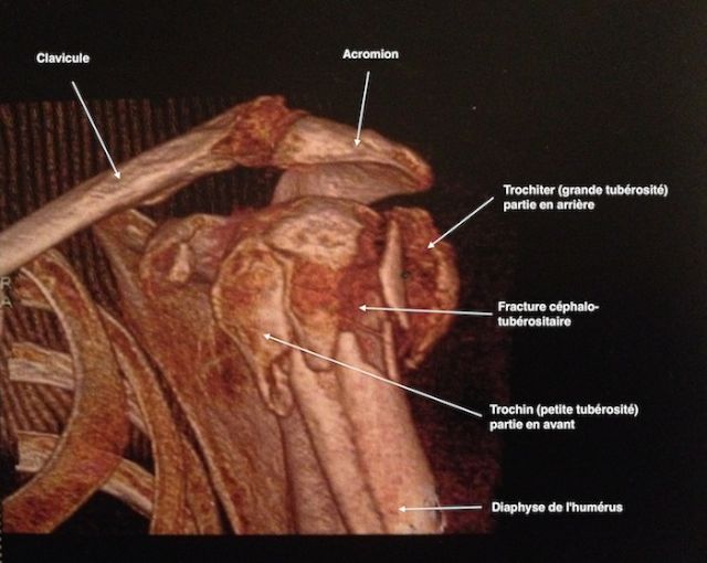 Reconstruction au scanner 3D d'une fracture 
            céphalo-tubérositaire de l'humérus