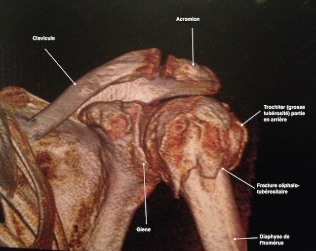 Reconstruction au scanner 3D d'une fracture 
            céphalo-tubérositaire de l'humérus 