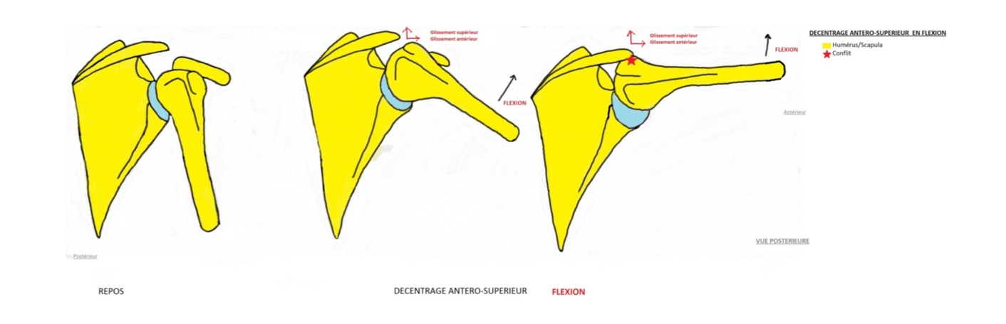 décentrage antero-supérieur de l'épaule