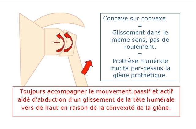 prothèse inversée de l'épaule