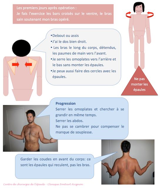 serrer omoplates, après opération d'une épaule instable 