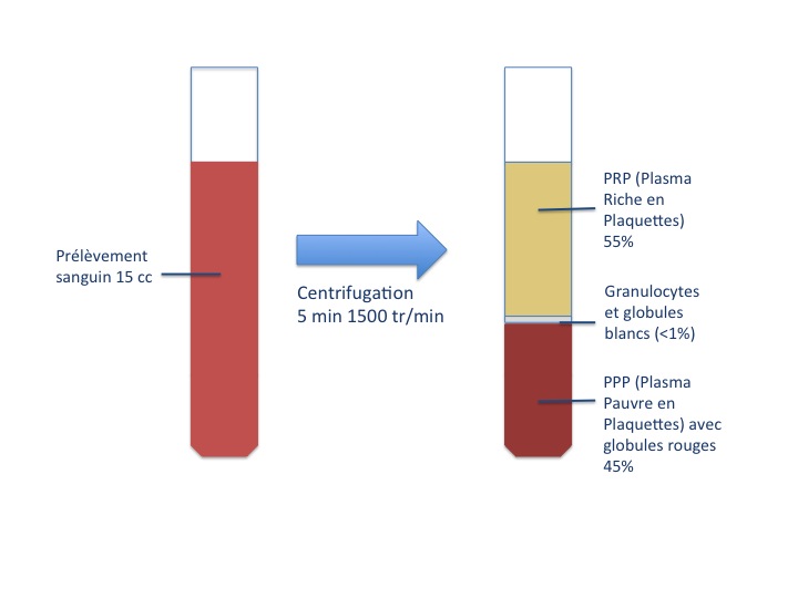 procédé de récupération du concentré 
              plaquettaire (PRP)
